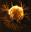 Image of Cancer cells like this one may soon be cured with the help of a genetically engineered virus.