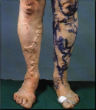 Image of An extreme case of varicose veins.