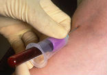 Image of Malaria continues to kill and sicken those across the Third World. More than 200 million people are infected with malaria each year, with a death toll as high as 1.2 million. 