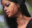 Image of About 90 percent of acid attack victims are women and children. 