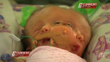 Image of The conjoined twins, Faith and Hope, suffer from a rare condition where they have two separate brains and faces, but share a head and body.