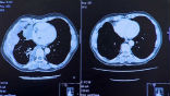 Image of Image scans of Steele's lungs before and after his treatment. The left scan shows numerous gray colored cancer tissues, which are gone in the right, after his treatment.