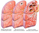 Image of Tuberculosis is a disease which slowly destroys the lungs of the infected person. Around 50% of those whose tuberculosis becomes active die if untreated.