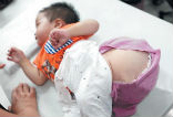 Image of This Chinese baby boy was born with a tumor at the base of his spine, which has now grown to the size of a melon.