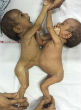 Image of Jannat and Mannat were born with omphalopaygus, a condition where twins are joined at the abdomen and lower chest (Barcroft India).