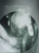 Image of Dying twin takes sister's hand in the womb (pix11).