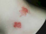 Image of Teen dies after hickey leads to deadly blood clot.