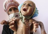 Image of There is a frightening rise in malnourished babies.