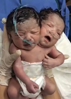 The conjoined twins have their own brains and head but share a single body (CEN).