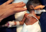 Image of The newborn boy measured at the length of an adult palm. [Photo by: Cover Asia Press]