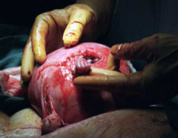 Image of Tremendous advances in our ability to provide Surgical help for children in the womb is showing the humanity of the unborn child and offering significant assistance to the Pro-Life cause. 