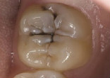Image of Fillings and root canals may become outdated dental practices (dentalpro).